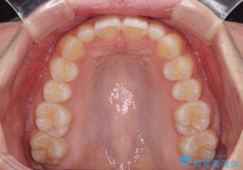 前歯のデコボコを治したい インビザラインによる矯正治療の治療後