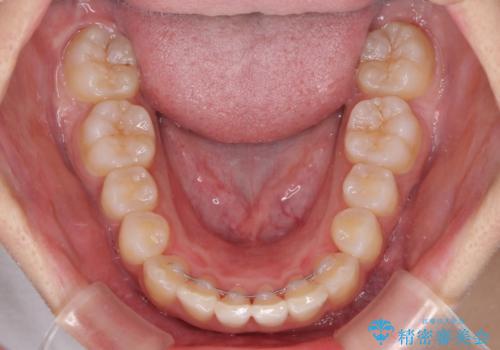 前歯のデコボコを治したい インビザラインによる矯正治療の治療後