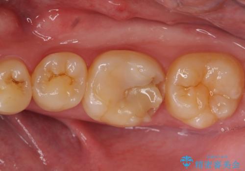 オールセラミッククラウン 欠けてしまった歯の治療の治療前