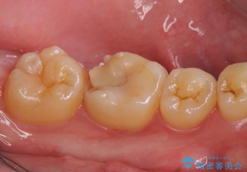 オールセラミッククラウン 欠けてしまった歯の治療の治療前