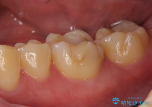 オールセラミッククラウン 欠けてしまった歯の治療の症例 治療前