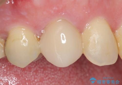 オールセラミッククラウン(スペシャル)　根管治療後の補綴の症例 治療前