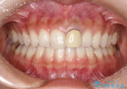 前歯のかぶせ物の色があっていない　オールセラミック治療の治療前