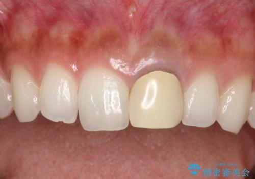 前歯のかぶせ物の色があっていない オールセラミック治療の治療前