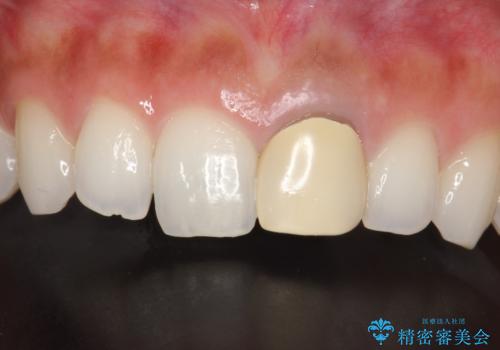前歯のかぶせ物の色があっていない オールセラミック治療の治療前