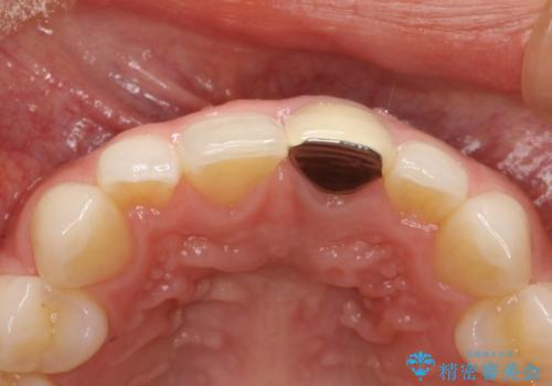 前歯のかぶせ物の色があっていない オールセラミック治療の治療前