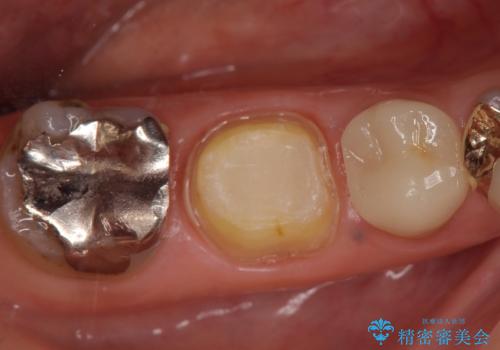 オールセラミッククラウン　歯茎が腫れてくる歯の治療の治療中