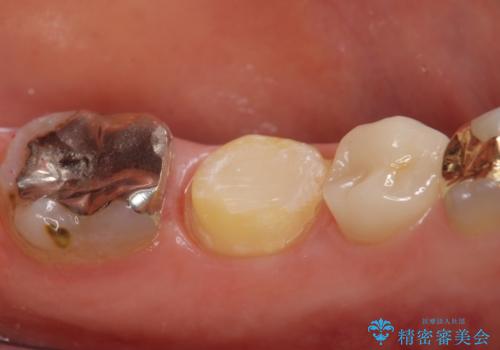 オールセラミッククラウン 歯茎が腫れてくる歯の治療の治療中