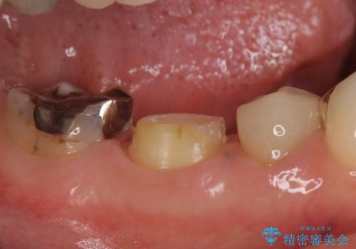 オールセラミッククラウン　歯茎が腫れてくる歯の治療の治療中