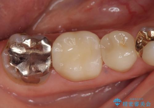 オールセラミッククラウン　歯茎が腫れてくる歯の治療の治療後