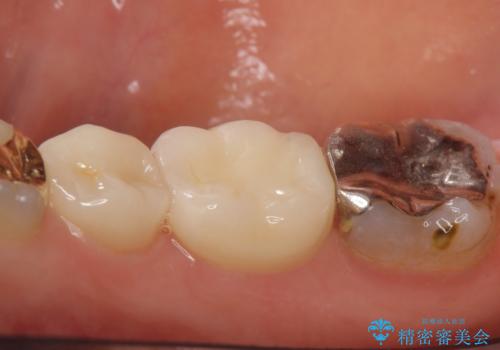 オールセラミッククラウン　歯茎が腫れてくる歯の治療の治療後