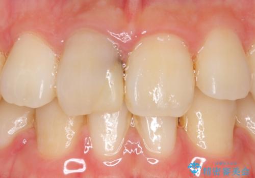 オールセラミッククラウン 変色した前歯の治療前