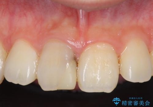オールセラミッククラウン 変色した前歯の治療前