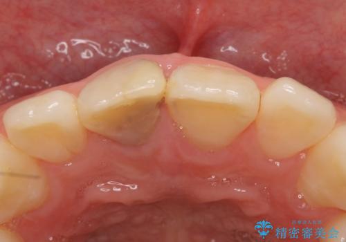 オールセラミッククラウン 変色した前歯の治療前