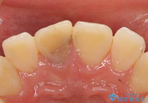 オールセラミッククラウン 変色した前歯の治療前
