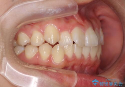 短期間で治療したい　目立たないワイヤー装置での非抜歯矯正の治療前