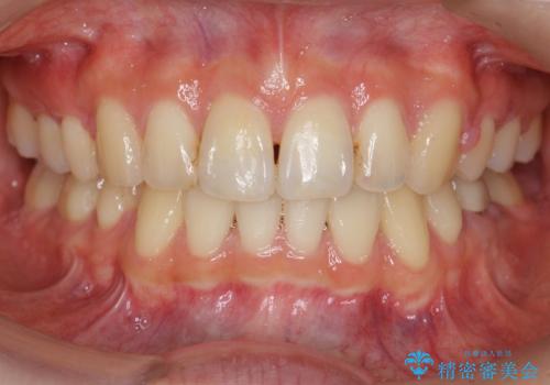 「整形した?」と言われるほどの変化! 口元を矯正治療で改善 鼻を高くしたわけでも、アゴに何か入れたわけでもありません。の症例 治療後