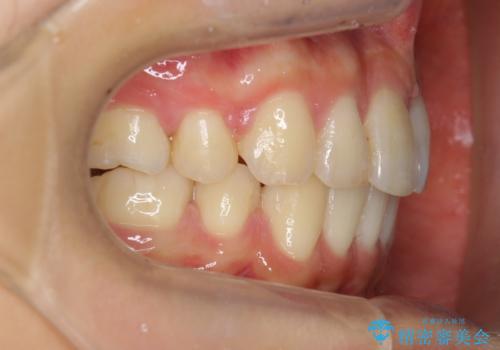 「整形した?」と言われるほどの変化! 口元を矯正治療で改善 鼻を高くしたわけでも、アゴに何か入れたわけでもありません。の治療後