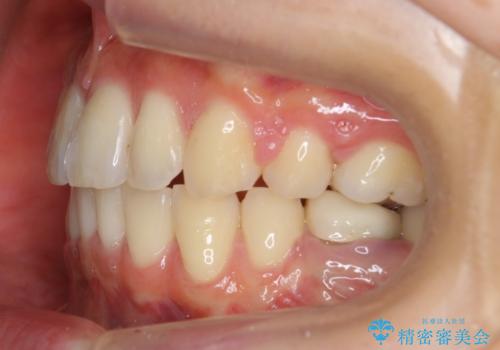 「整形した?」と言われるほどの変化! 口元を矯正治療で改善 鼻を高くしたわけでも、アゴに何か入れたわけでもありません。の治療後