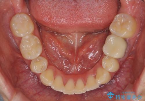 「整形した?」と言われるほどの変化! 口元を矯正治療で改善 鼻を高くしたわけでも、アゴに何か入れたわけでもありません。の治療後