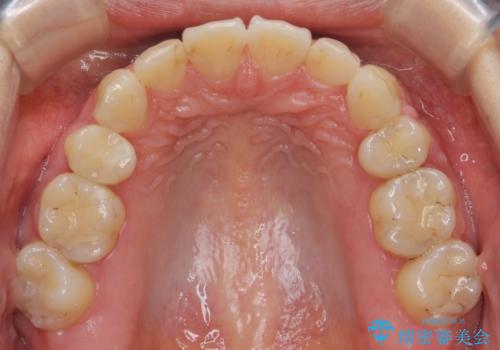 「整形した?」と言われるほどの変化! 口元を矯正治療で改善 鼻を高くしたわけでも、アゴに何か入れたわけでもありません。の治療後