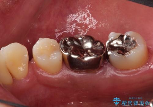 奥歯が痛い。ブリッジによる欠損補綴の治療前