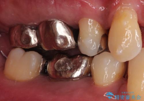 奥歯が痛い。ブリッジによる欠損補綴の治療前