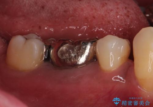 奥歯が痛い。ブリッジによる欠損補綴の治療前