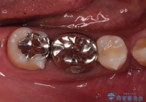 奥歯が痛い。ブリッジによる欠損補綴の治療前