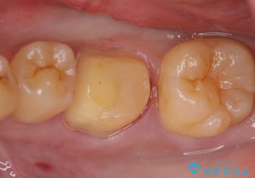 オールセラミッククラウン 欠けてしまった歯の治療の治療中