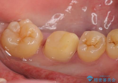 オールセラミッククラウン 欠けてしまった歯の治療の治療中
