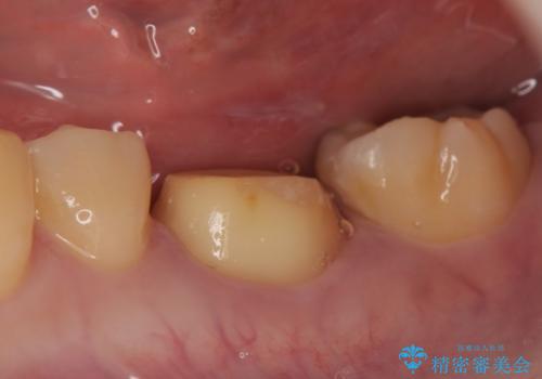 オールセラミッククラウン 欠けてしまった歯の治療の治療中