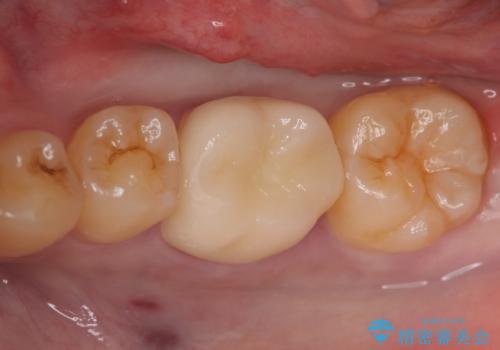 オールセラミッククラウン 欠けてしまった歯の治療の治療後