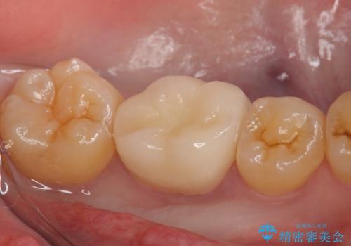 オールセラミッククラウン 欠けてしまった歯の治療の治療後