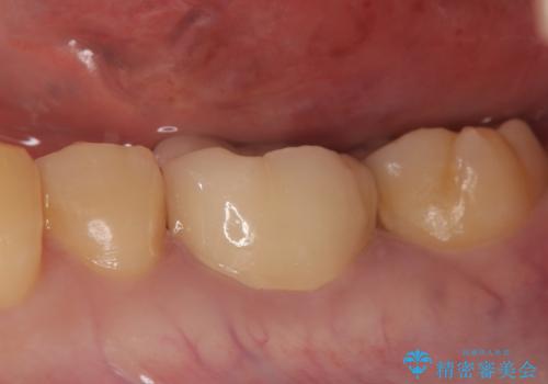 オールセラミッククラウン 欠けてしまった歯の治療の症例 治療後