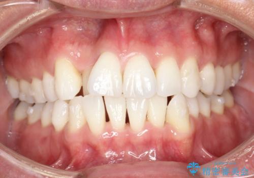 内側に入ってしまった前歯を正しい位置へ  インビザライン矯正の治療中