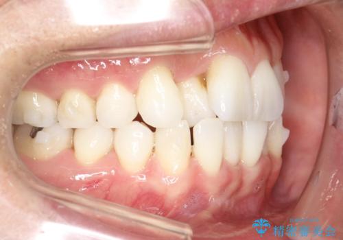 内側に入ってしまった前歯を正しい位置へ  インビザライン矯正の治療中