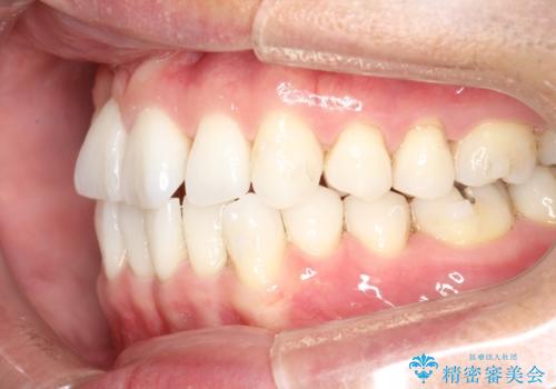 内側に入ってしまった前歯を正しい位置へ  インビザライン矯正の治療中