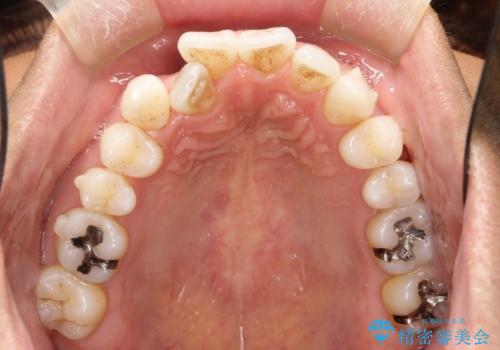 内側に入ってしまった前歯を正しい位置へ  インビザライン矯正の治療中