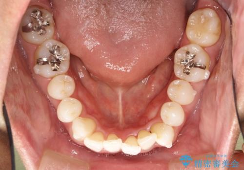 内側に入ってしまった前歯を正しい位置へ  インビザライン矯正の治療中