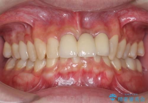 前歯にボールが当たってダメになってしまった とりあえず横の歯に接着剤でつけてしのいでいたのを、しっかりブリッジで治療の治療後