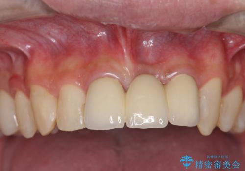 前歯にボールが当たってダメになってしまった とりあえず横の歯に接着剤でつけてしのいでいたのを、しっかりブリッジで治療の症例 治療後