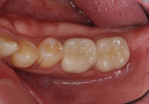 放置した虫歯の治療　親知らずの手前が虫歯の治療後