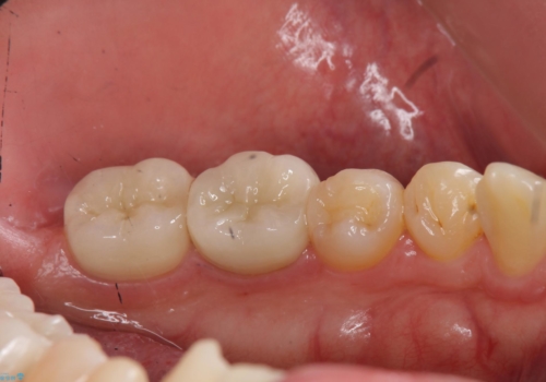放置した虫歯の治療 親知らずの手前が虫歯の治療後