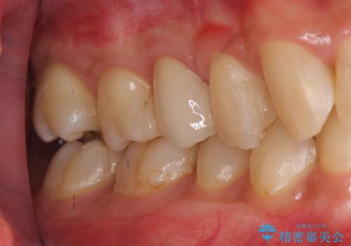放置した虫歯　歯ぐきの中まで虫歯でも、しっかり健康的な部分を引っ張り出して、きちんと処置します。の治療後