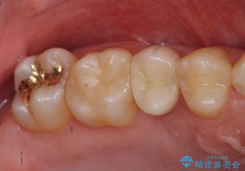 放置した虫歯　歯ぐきの中まで虫歯でも、しっかり健康的な部分を引っ張り出して、きちんと処置します。の治療後