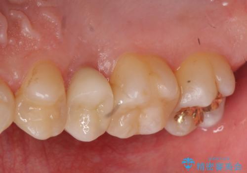 放置した虫歯 歯ぐきの中まで虫歯でも、しっかり健康的な部分を引っ張り出して、きちんと処置します。の治療後