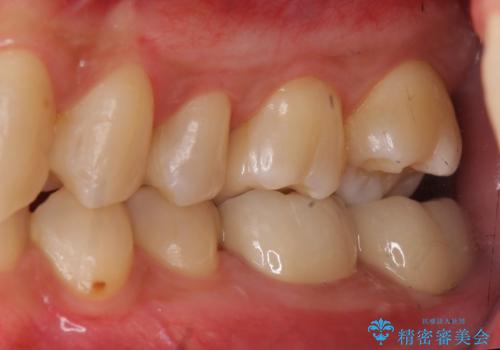 放置した虫歯の治療 親知らずの手前が虫歯の治療後