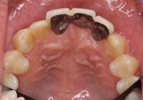 前歯にボールが当たってダメになってしまった とりあえず横の歯に接着剤でつけてしのいでいたのを、しっかりブリッジで治療の治療後