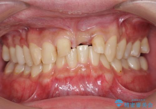 前歯にボールが当たってダメになってしまった とりあえず横の歯に接着剤でつけてしのいでいたのを、しっかりブリッジで治療の治療中